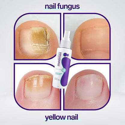 Nail Fungus Spray (Original)